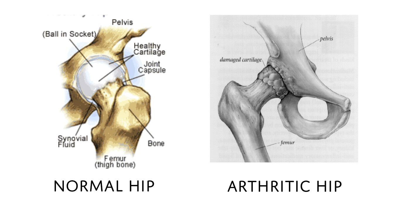 hip bursitis diagram • BODY FIRST UK